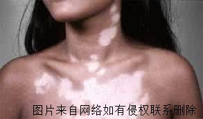 女性脸部白癜风可使用化妆品么