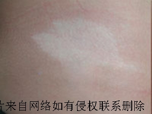 女性白癜风患者如何护理