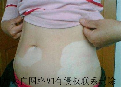 女性手臂上白癜风有什么危害