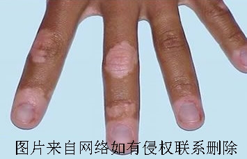 手部节段型白癜风的常见症状